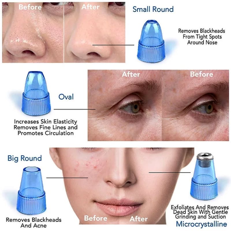4 in 1 Blackhead Remover Device