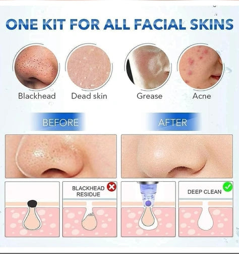 4 in 1 Blackhead Remover Device